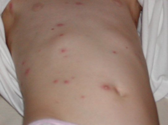 Baking Soda Uses For Skin Rashes - 543x405 - jpeg Abdominal Rash Causes