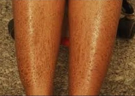 Dry Skin on Legs Looks Scales