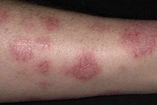 severe dry skin on legs