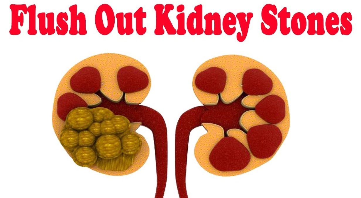 Get Rid Of Kidney Stones Naturally Get Rid Of Kidney Stones Naturally