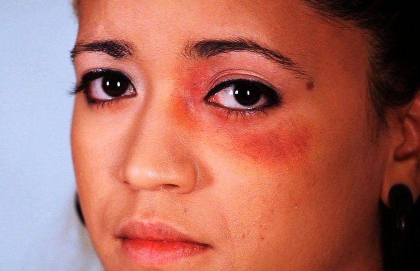 How to Get Rid of a Black Eye